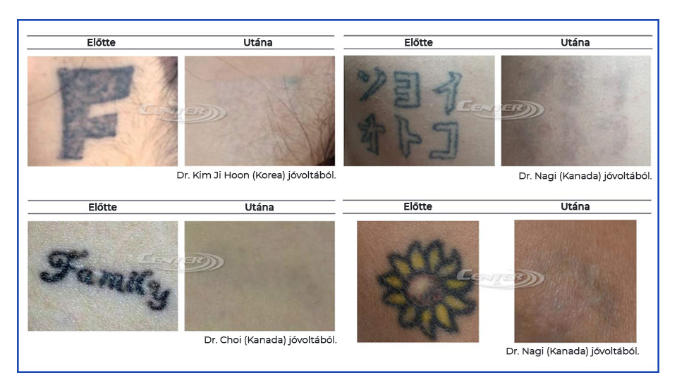 Tetoválás eltávolítás eredménye Nd:YAG lézerrel