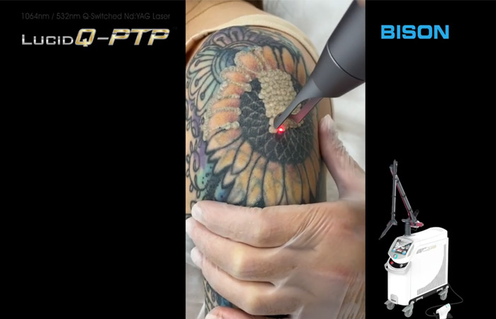 BISON LUCID Q-PTP - tetoválás eltávolítás