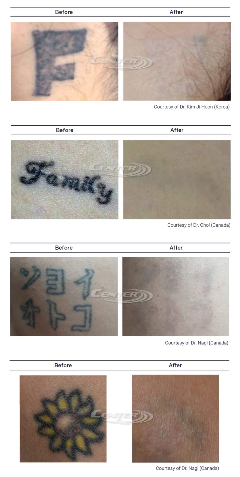 PicoLO tetoválás eltávolítás előtte-utána képek