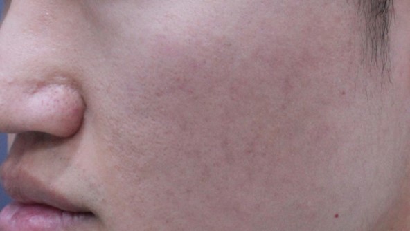 PicoLO Premium acnes hegek - utána