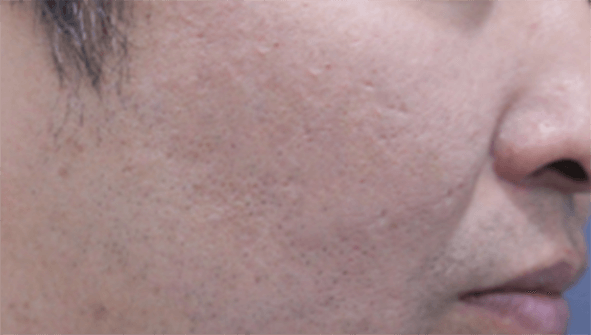 PicoLO Premium acnes hegek - utána