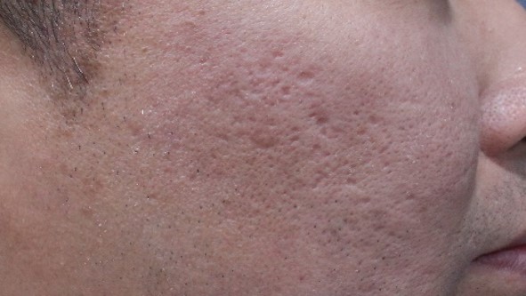 PicoLO Premium acnes hegek - előtte