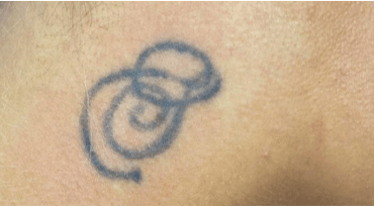 PicoLO Premium tetoválás eltávolítás - előtte