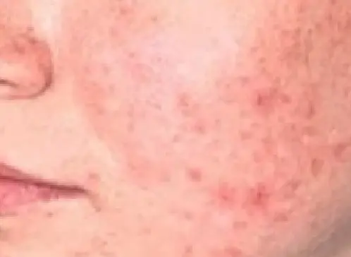 ADVATx - acne - előtte
