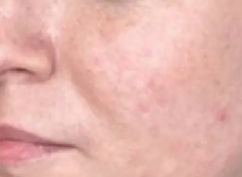 ADVATx - acne - utána