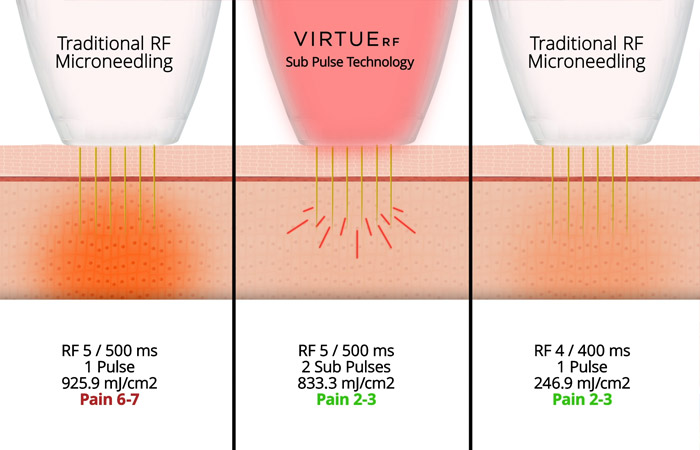 VIVACE VirtueRF Sub-Pulse technológia