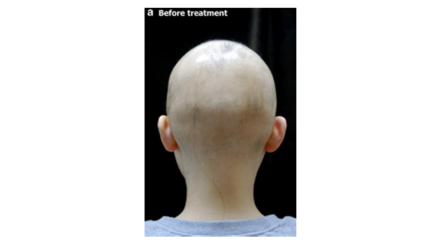 PALLAS - alopecia areata - előtte