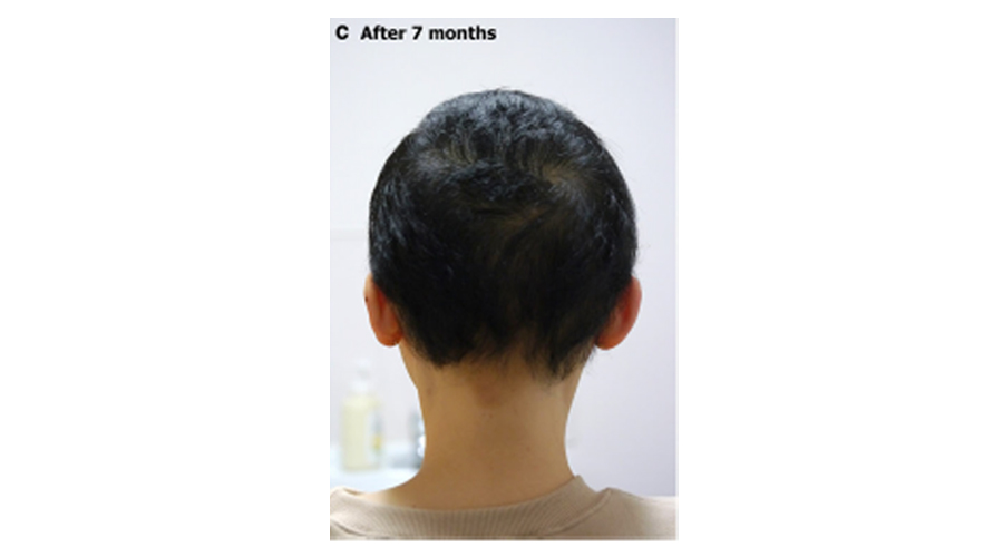 PALLAS - alopecia areata - utána