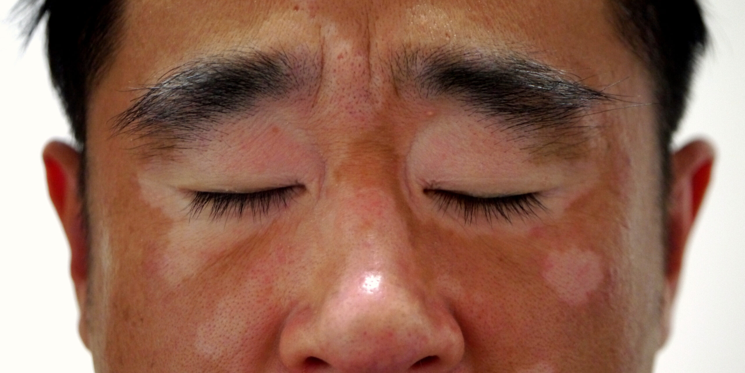 PALLAS - vitiligo - előtte