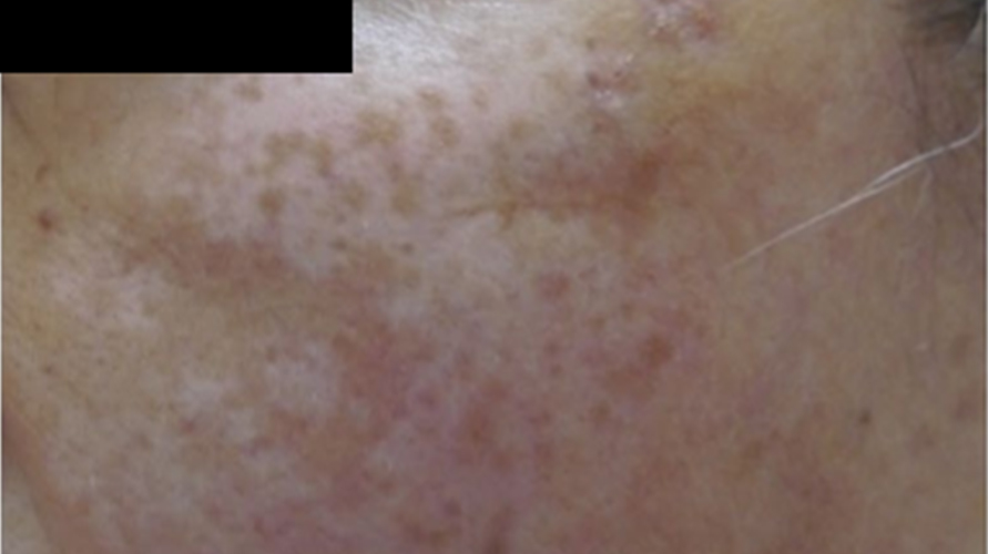 PALLAS - vitiligo - előtte
