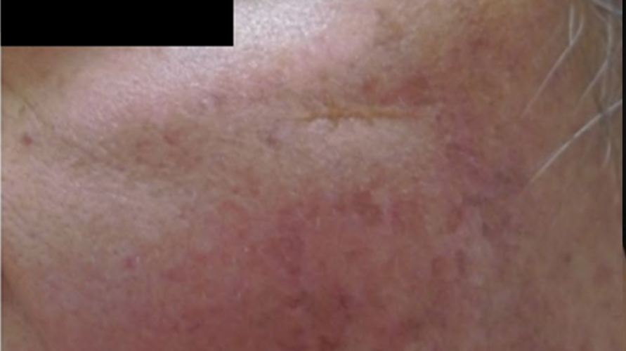 PALLAS - vitiligo - utána