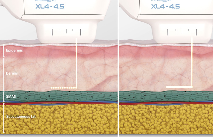 EunSung LIPOGE-X arcfiatalító kezelés illusztráció
